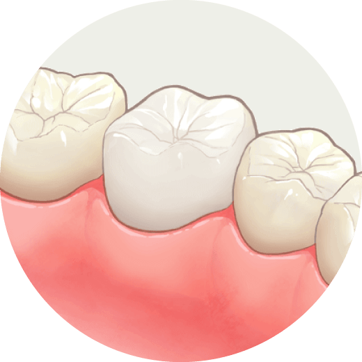 ジルコニア クラウン
