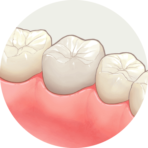 オールセラミック クラウン