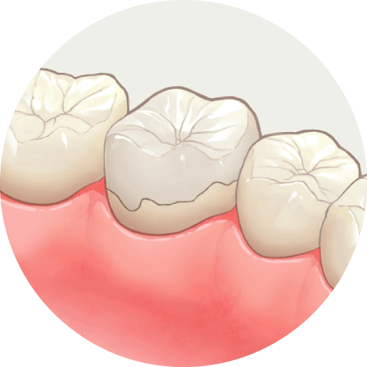 セラミックオーバーレイ