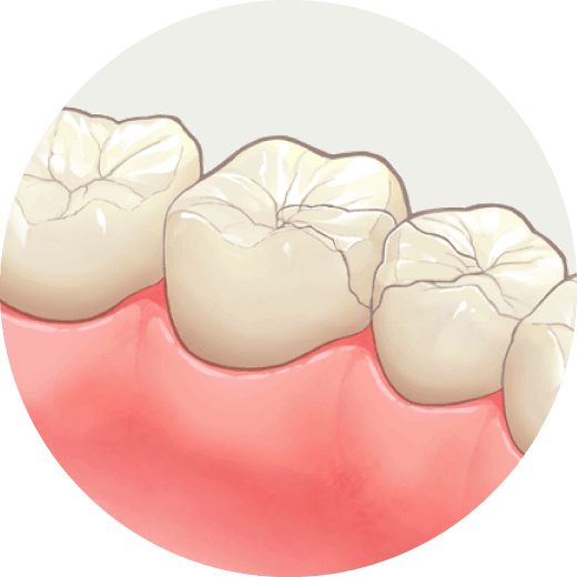 セラミックインレー