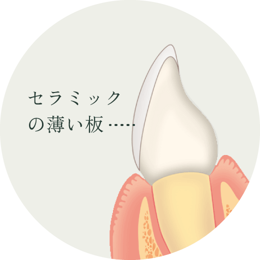 ラミネートベニア