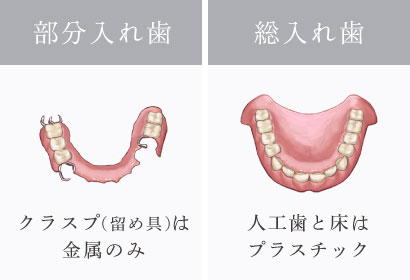 部分入れ歯：クラスプ（留め具）は金属のみ／総入れ歯：人工歯と床はプラスチック