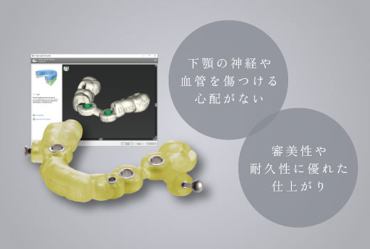 下顎の神経や血管を傷つける心配がない/審美性や耐久性に優れた仕上がり