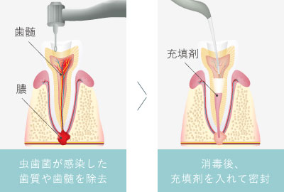 虫歯菌が感染した歯質や歯髄を除去 消毒後、充填剤を入れて密封