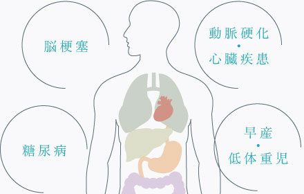 脳梗塞、動脈硬化・心臓疾患、糖尿病、早産・低体重児