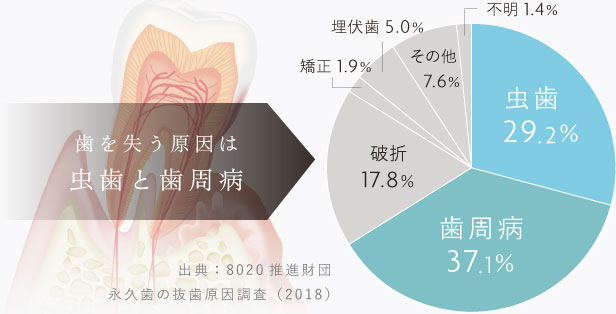 歯を失う原因は虫歯と歯周病